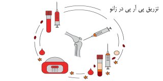 تزریق پی آر پی زانو برای درمان کدام مشکلات زانو مناسب است؟