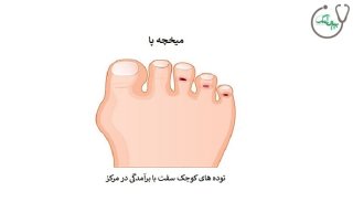 علت ایجاد میخچه پا چیست و چگونه درمان می شود؟
