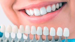 بهترین برند لمینت دندان کدام است؟