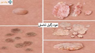چرا زگیل تناسلی عود میکند و علائم آن چیست؟