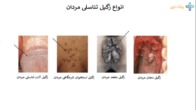0 تا 100 زگیل تناسلی مردان