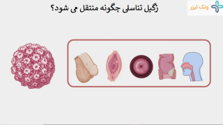 بررسی روشهای انتقال زگیل تناسلی