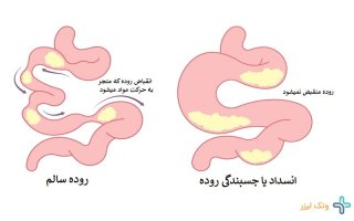 از کجا بفهمیم به چسبندگی روده مبتلا هستیم؟ (تشخیص و علائم)