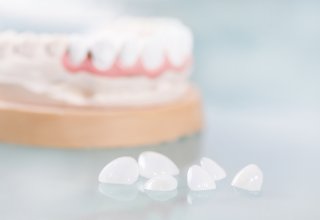 فرق لمینت و کامپوزیت چیست؟