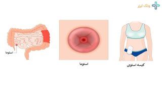 عمل استومی چیست و چگونه انجام می شود؟