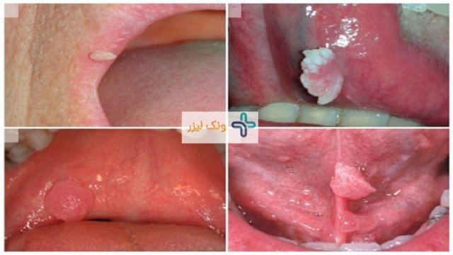 علت ابتلا به زگیل در دهان چیست و چگونه درمان می شود؟