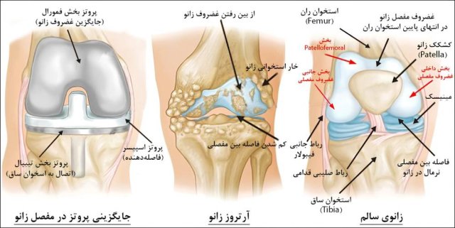 عمل تعویض مفصل زانو چیست؟