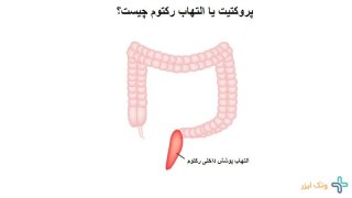 از کجا بفهمیم التهاب رکتوم داریم؟