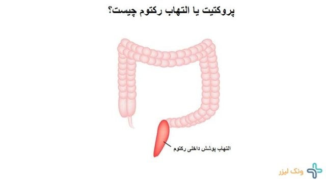 از کجا بفهمیم التهاب رکتوم داریم؟