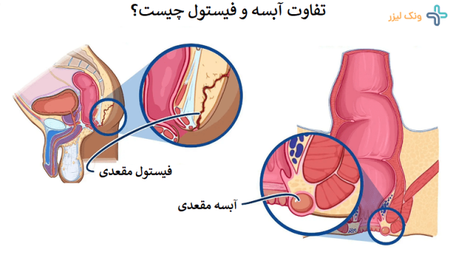 تفاوت آبسه مقعد با فیستول چیست؟