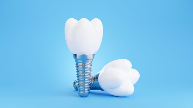 ایمپلنت دندان؛ راه‌حلی دائمی برای لبخندی دوباره