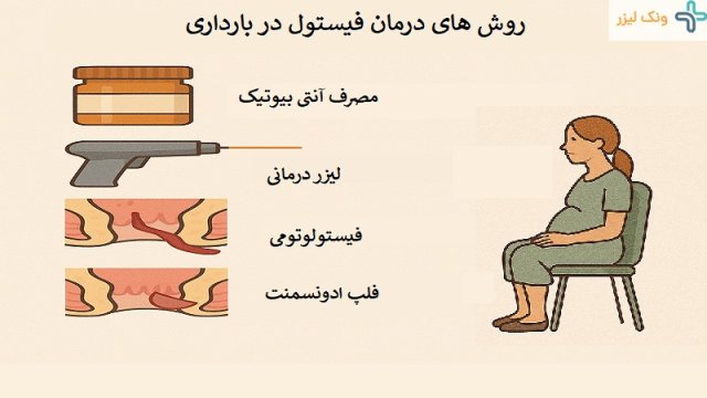 چگونه فیستول مقعدی را در بارداری درمان کنیم؟