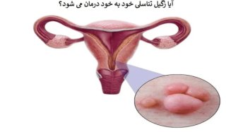 آیا زگیل تناسلی خود به خود درمان می شود و اگر نشد چه کنیم؟