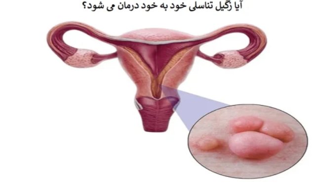 آیا زگیل تناسلی خود به خود درمان می شود و اگر نشد چه کنیم؟