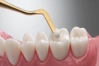 زیبایی لبخند با کمک متخصص کامپوزیت غرب تهران