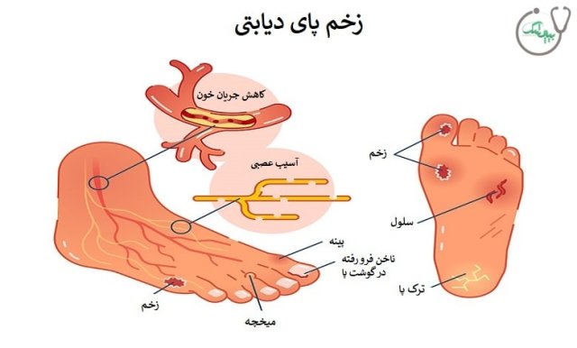 زخم پای دیابتی چیست؟
