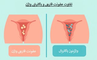 عفونت قارچی و واژینوز باکتریال چه تفاوت هایی دارند؟
