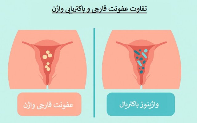 عفونت قارچی و واژینوز باکتریال چه تفاوت هایی دارند؟