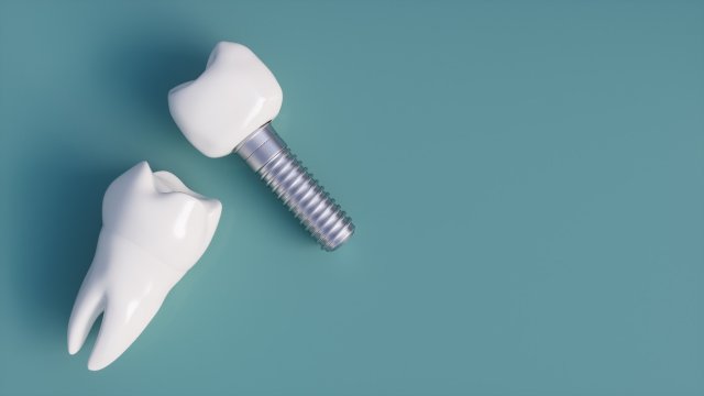 بریج یا ایمپلنت دندان؛ کدام بهتر است؟