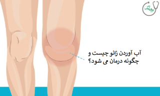 درمان آب آوردن زانو