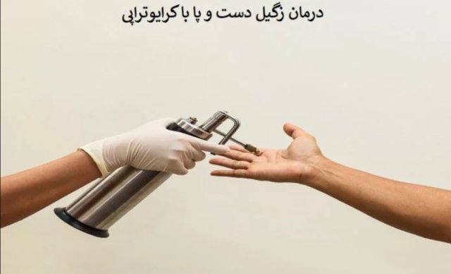 کرایو زگیل دست و پا چه عوارضی دارد؟