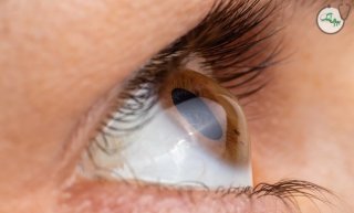 قوز قرنیه چیست و چه علائمی دارد؟